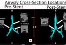 Airway/Lung Stent Market Estimated to Expand at a Robust CAGR by 2017 – 2026