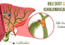 Bile Duct Cancer (Cholangiocarcinoma) Treatment Market Foreseen to Grow Exponentially by 2017 – 2025