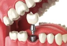 Dental Implants Market Size, Share, Trend and Industry Analysis Report 2019 – 2027