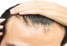 How the fut hair plantation treatment helps, and why is it better?