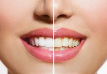 Sign Up for Whiter Teeth
