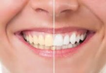 Teeth whitening