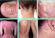 Eyeing New Product Launches, Companies In Psoriasis Treatment Market To Remain Hopeful In The Next Few Years