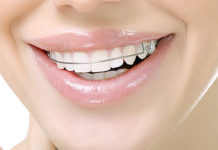Healthy Guide On How To Maintain Your Dental Retainer Dental