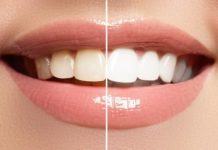 Solution for Teeth Whitening