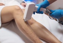 Is laser hair removal forever?