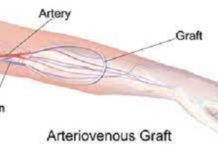 Vascular Graft Market Research Revealing The Growth Rate And Business Opportunities To 2026