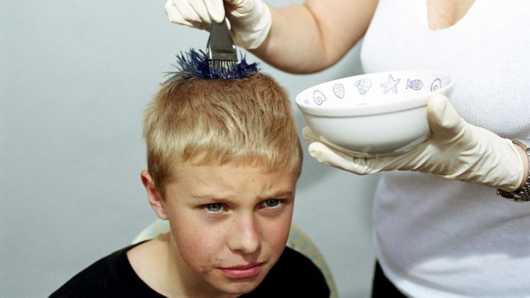 what to do with burnt scalp
