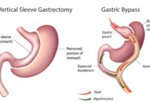 Gastric bypass and Gastric Sleeve in Turkey