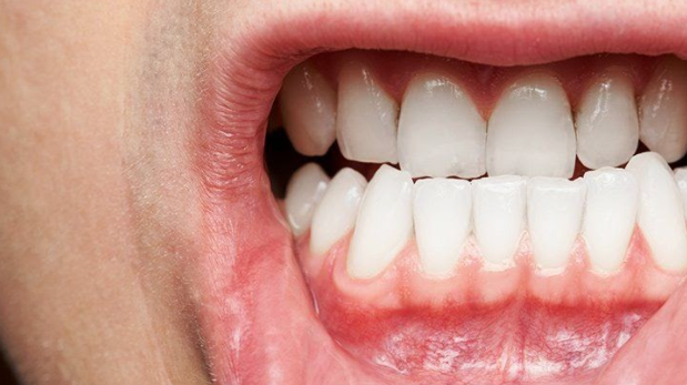 Gum disease (periodontal disease) 