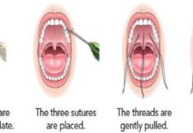 SNORING vs SLEEP APNEA TREATMENT WITH FACE LIFTING THREADS AND OWNS PATIENT BLOOD