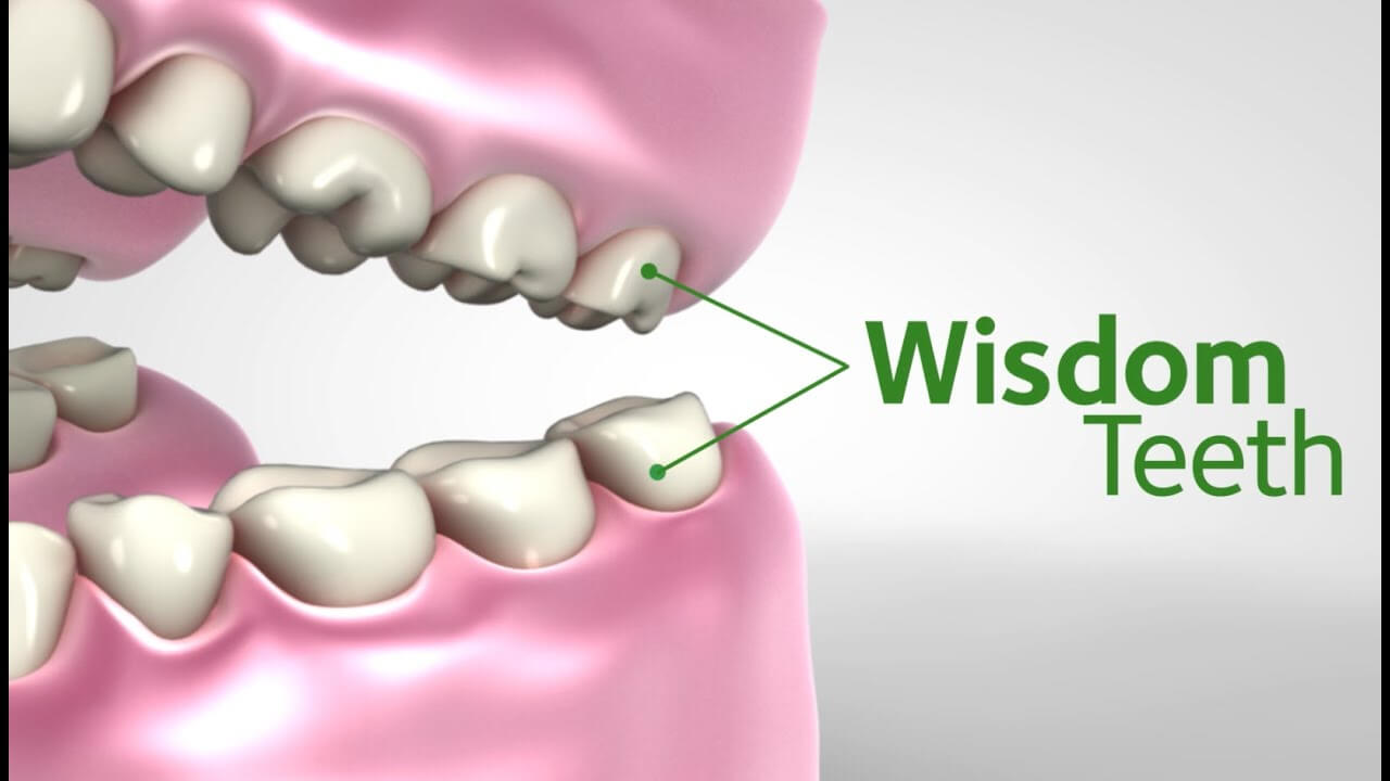 Wisdom Teeth Big Black Cock