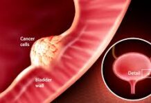 Risk Factors for Bladder Cancer