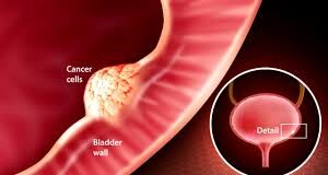 Risk Factors for Bladder Cancer