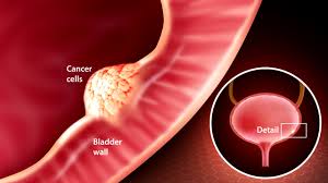 Risk Factors for Bladder Cancer
